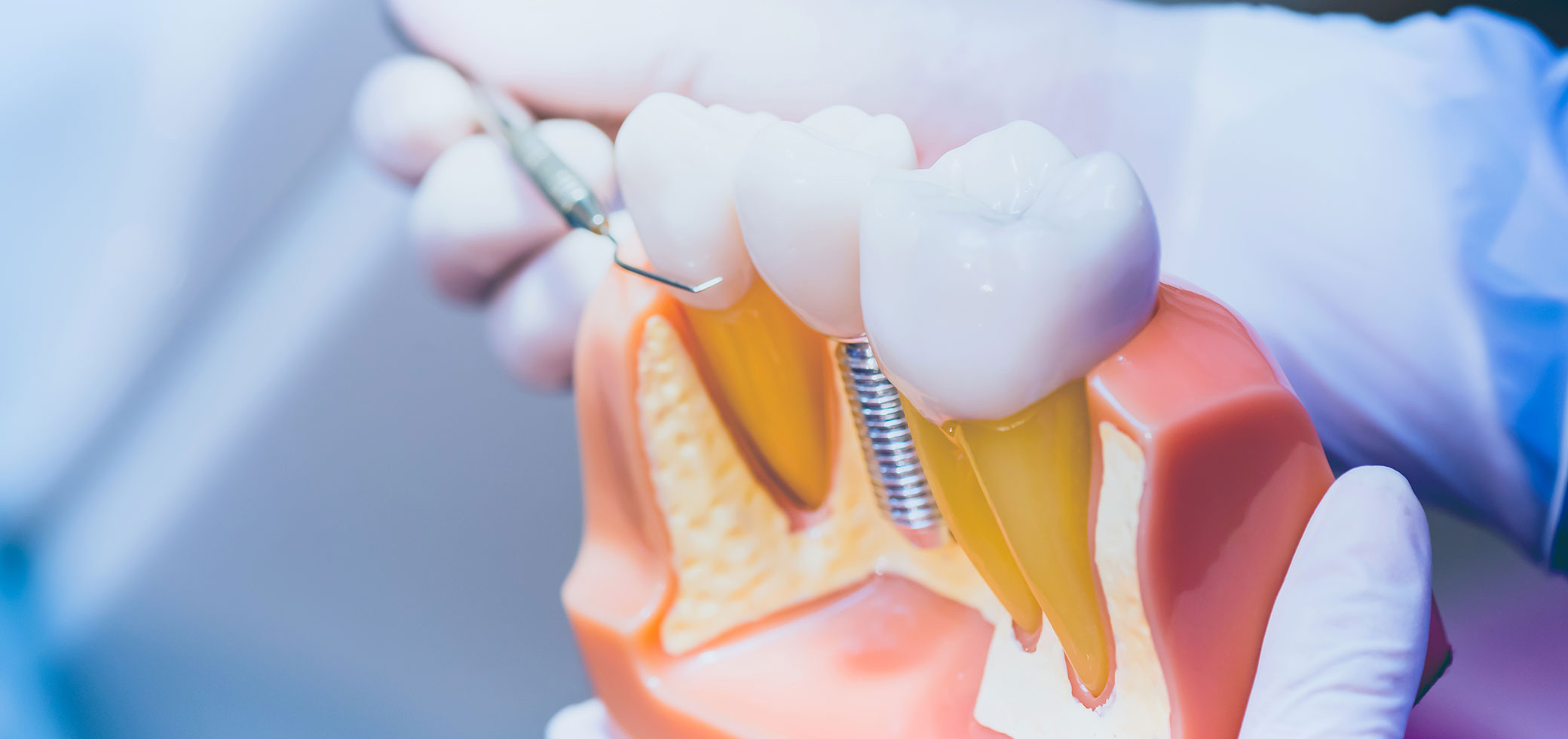 歯周病とインプラントの関係性